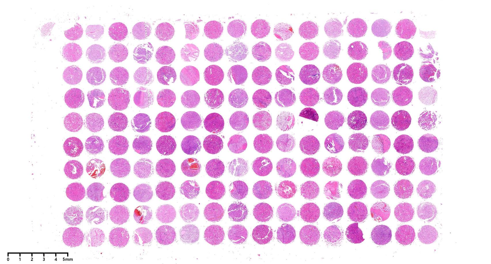 AF-KicSur2201肾透明细胞癌组织芯片
